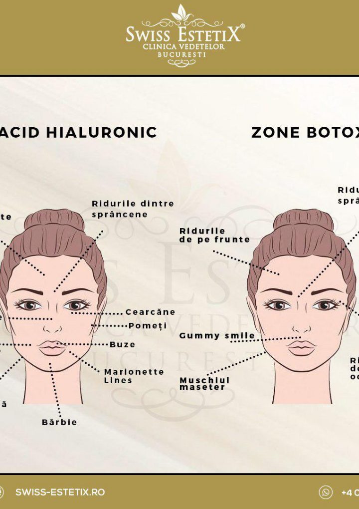 Acid hialuronic vs Botox. Află acum diferenţele!