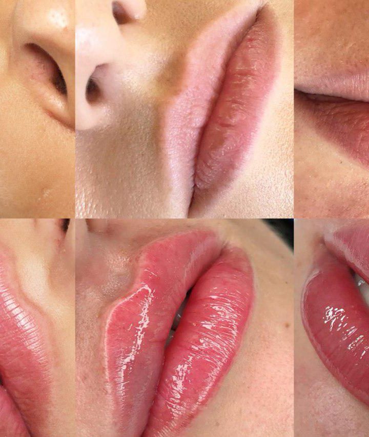 Mituri despre volumizarea buzelor cu acid hialuronic